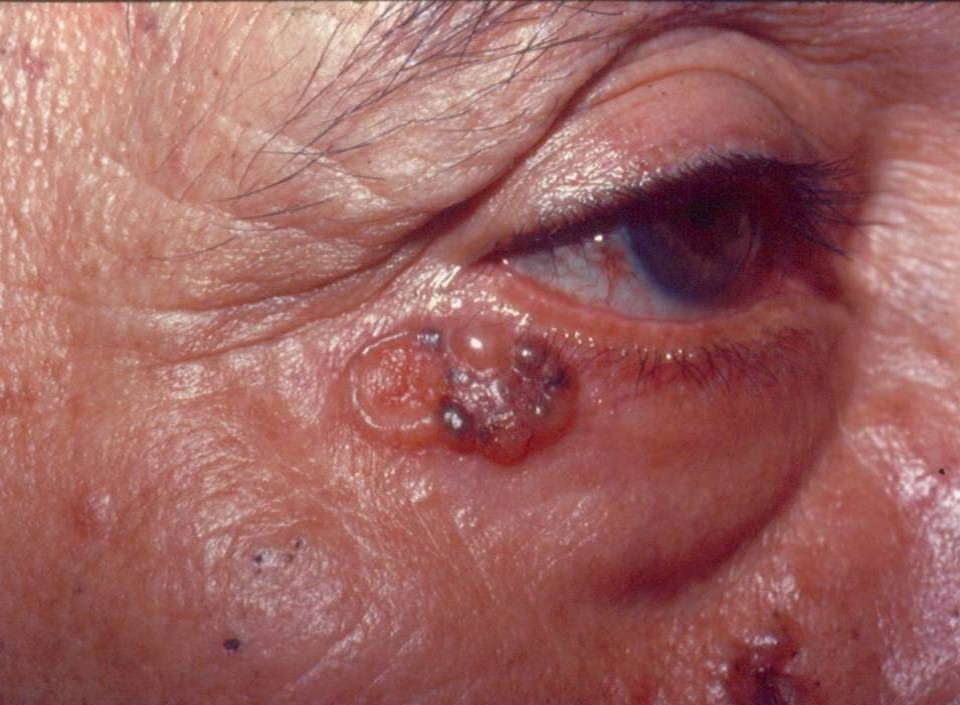 Carcinoma Basocelular