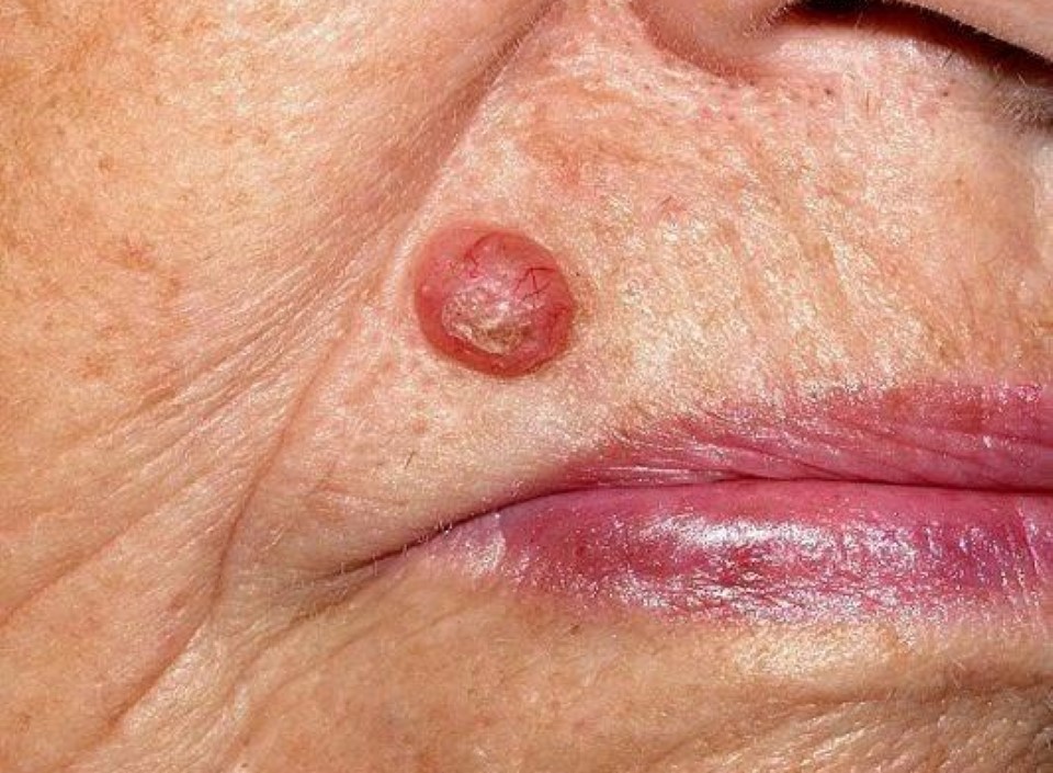 Carcinoma Basocelular